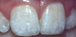 Fluorosis is becoming common in both adults and children